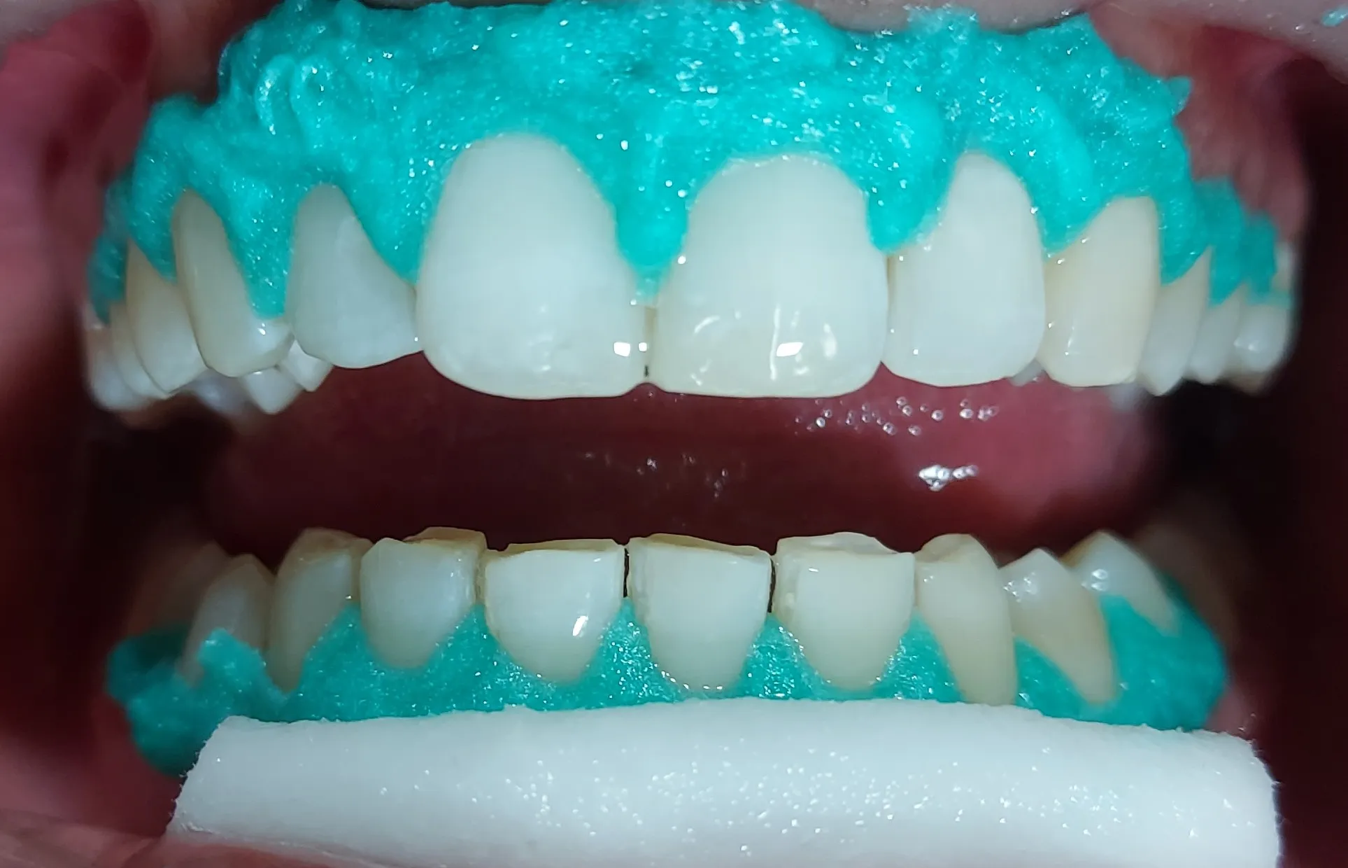 34033 night teeth whitening image4