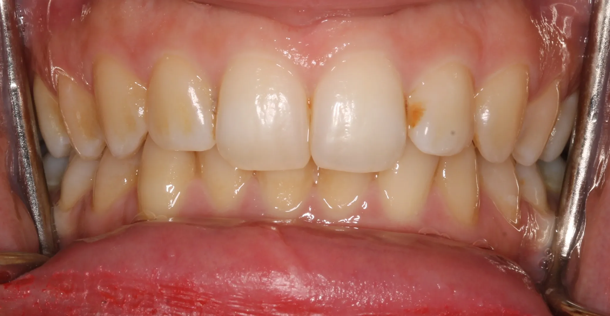 34033 night teeth whitening image6