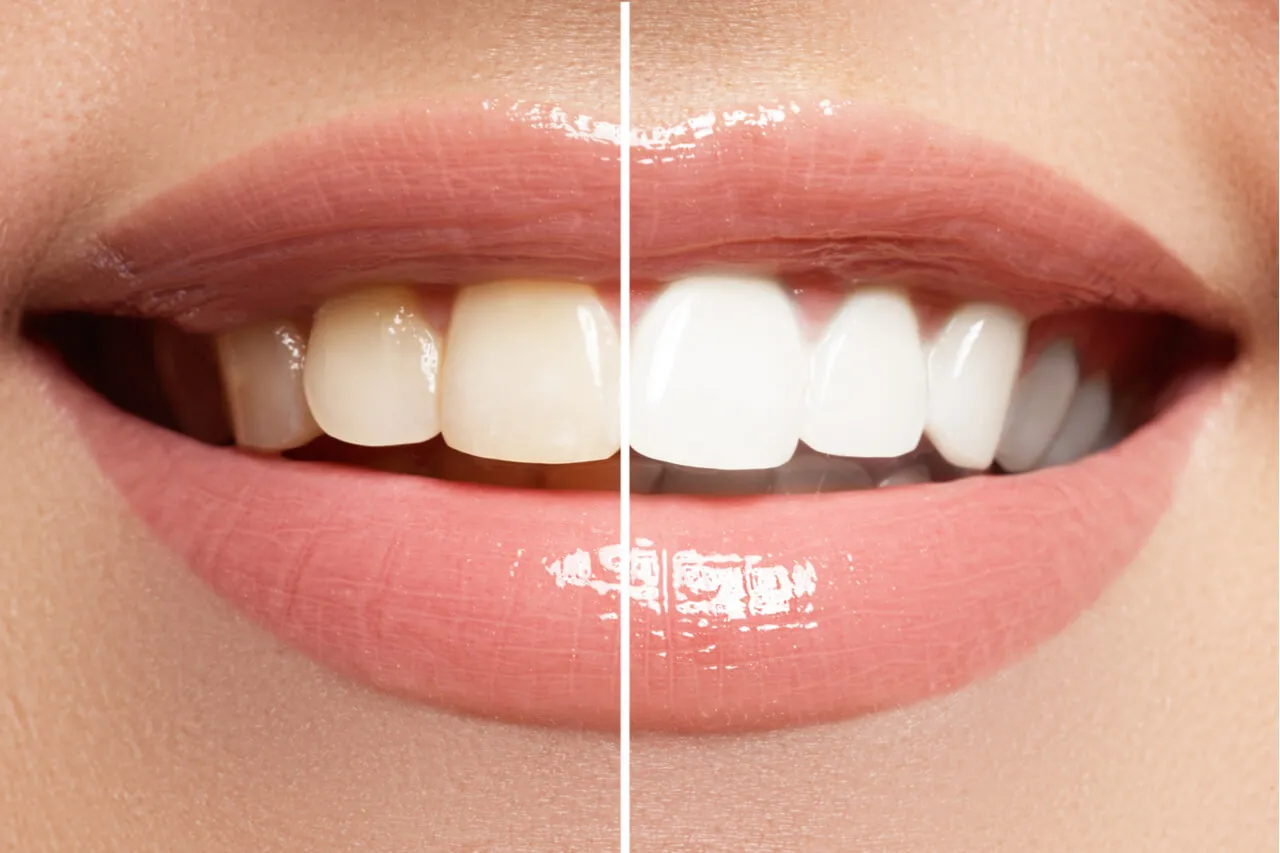34033 night teeth whitening image7