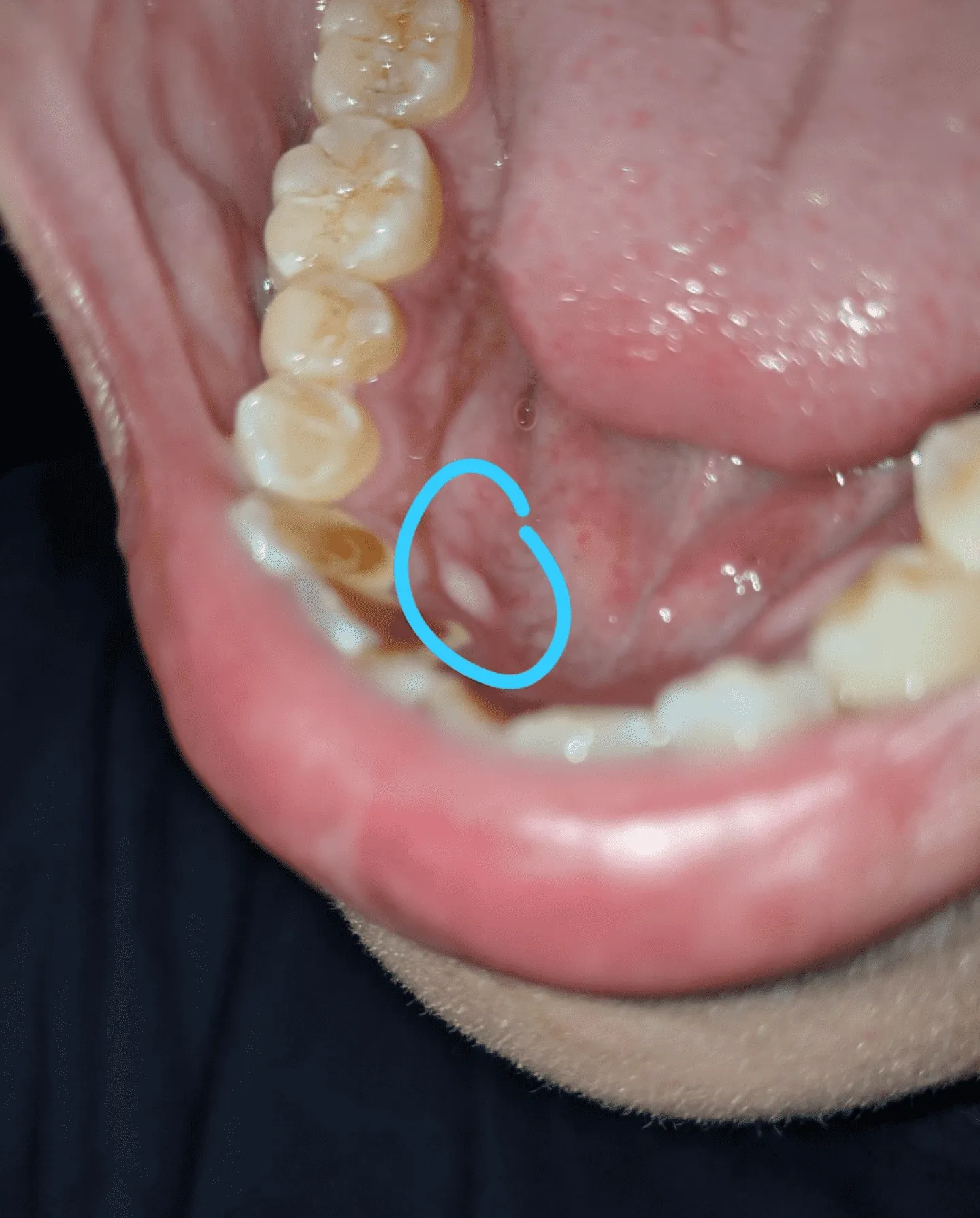 34034 gingival recession