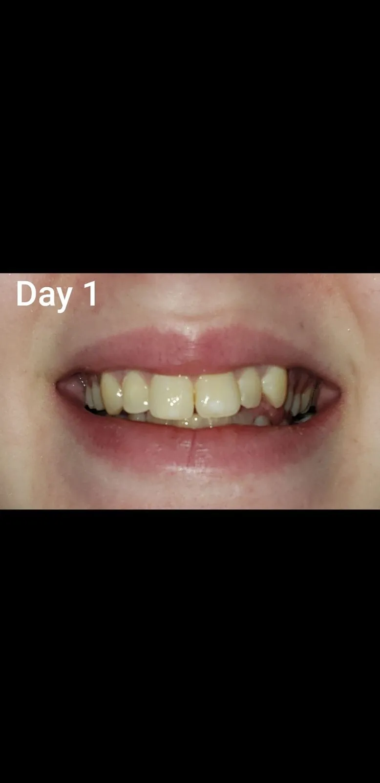 34041 charcoal teeth