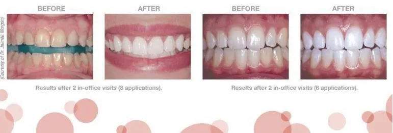 34042 opalescence boost whitening dentist