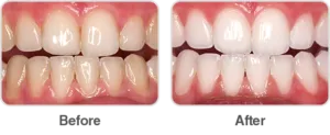 34042 opalescence boost whitening smile