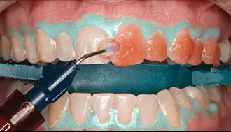 34042 opalescence boost whitening teeth stains