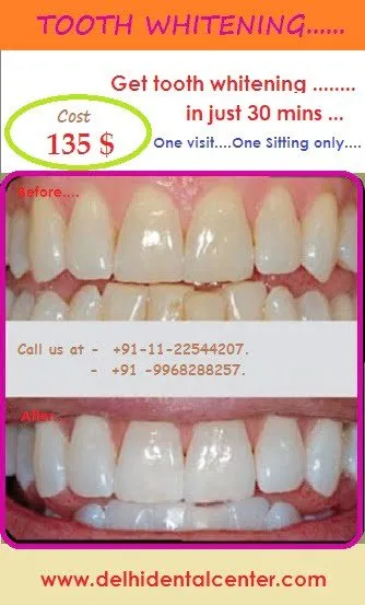 34043 teeth whitening aftercare