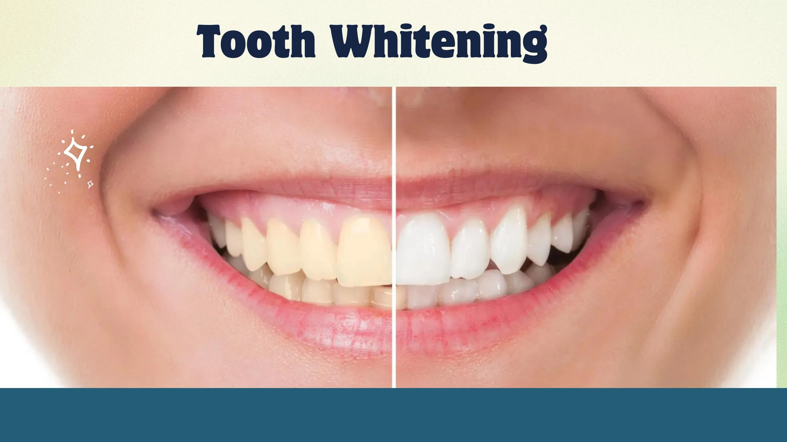 /img/34051-teeth-whitening-results.webp