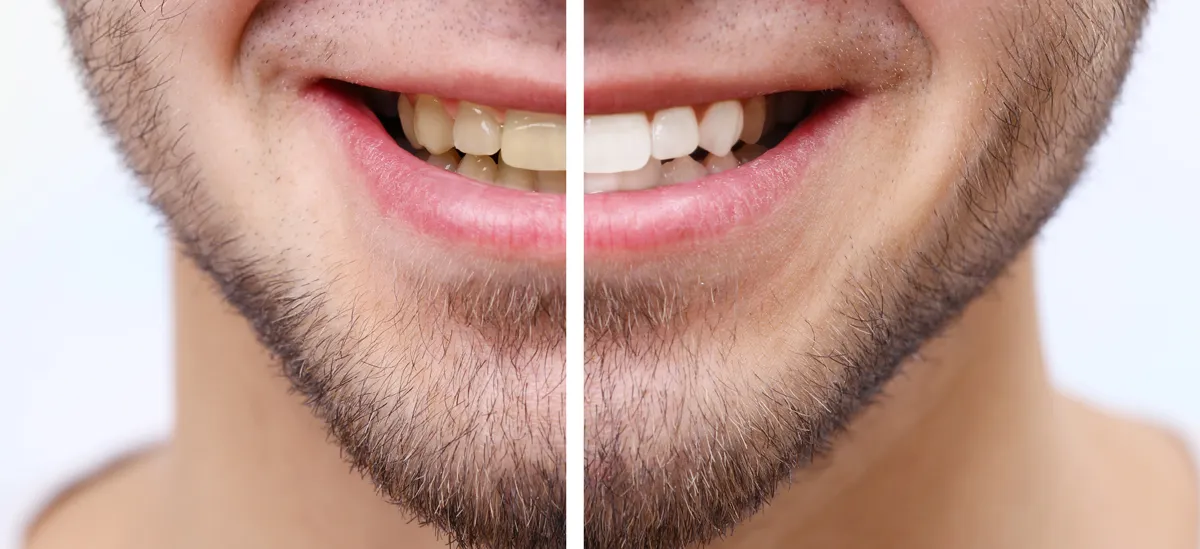 34054 kor whitening system