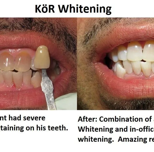 34054 teeth whitening results