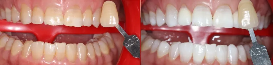 34058 at home teeth whitening