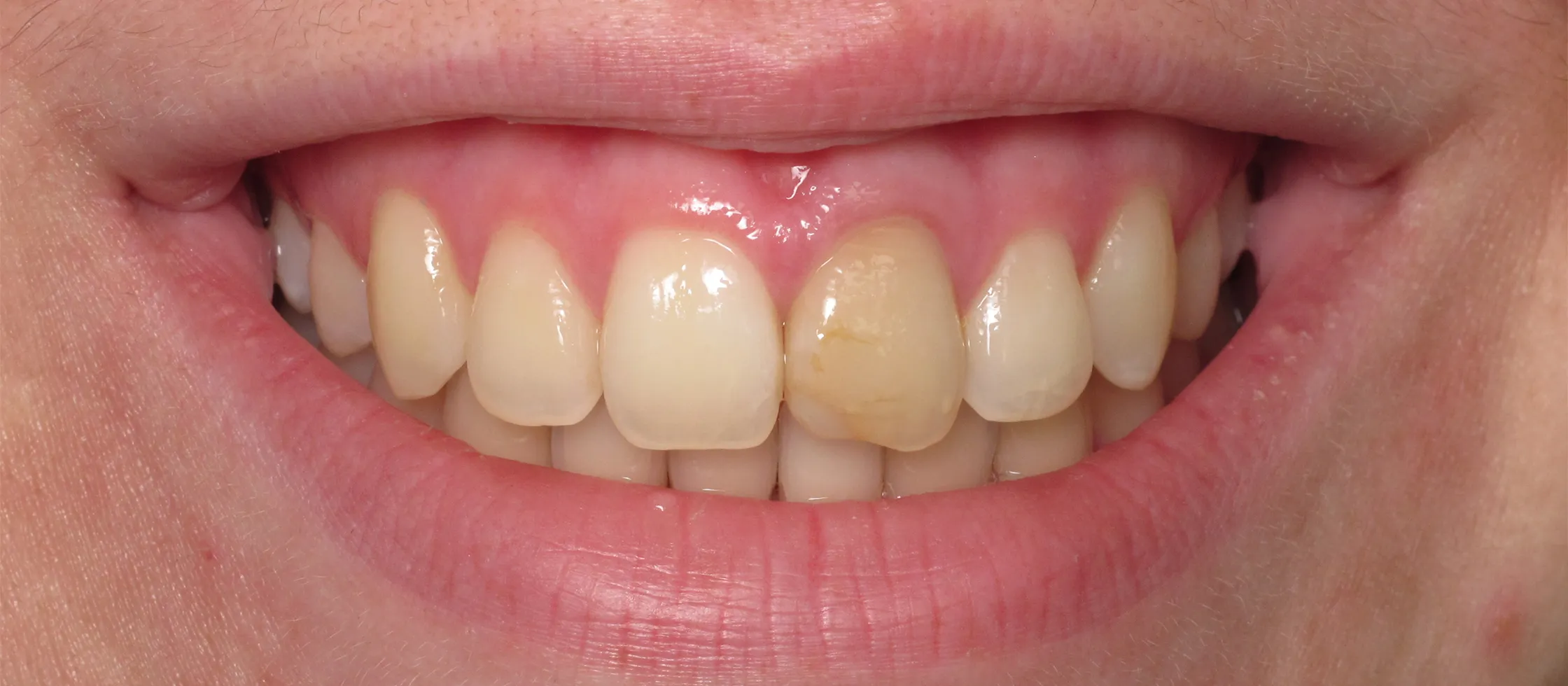 34060 teeth whitening confidence
