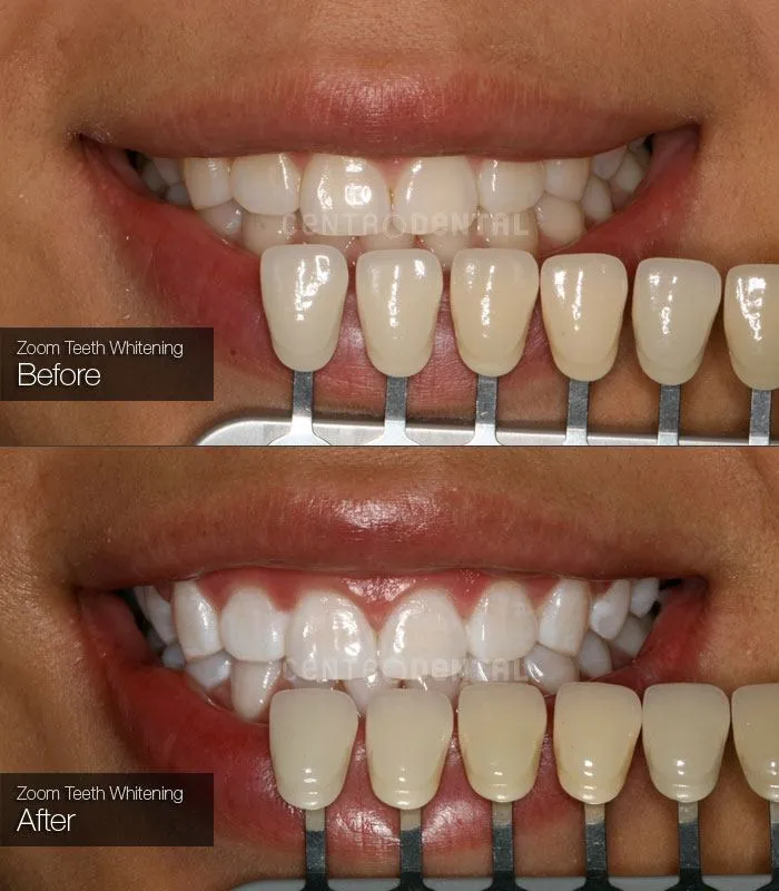 34062 zoom teeth whitening before after