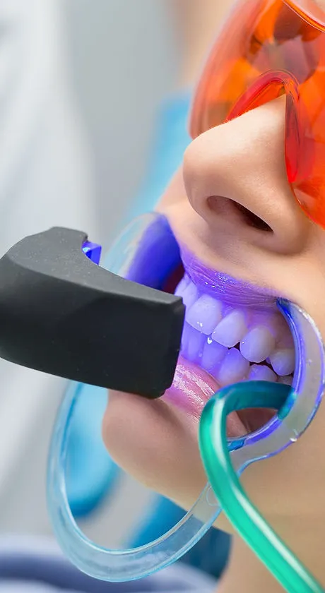 34069 zoom teeth whitening bolton smile