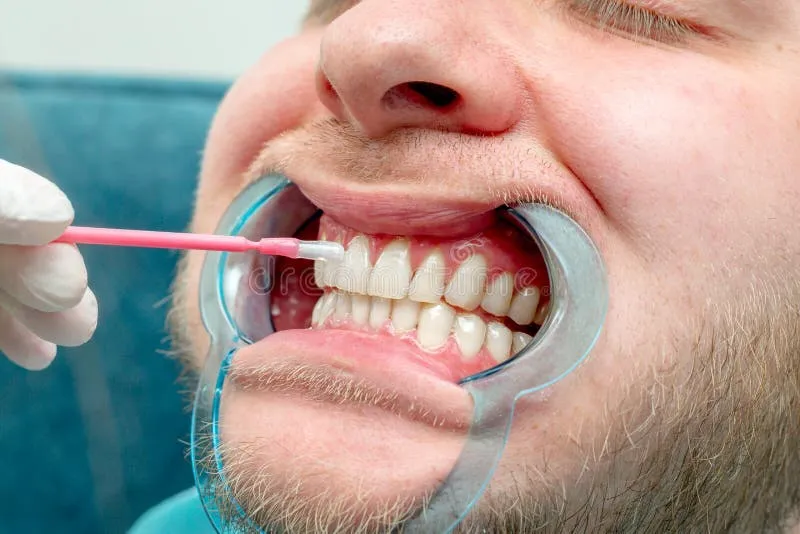 34081 laser teeth whitening