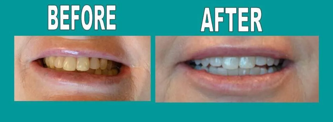 34082 at home teeth whitening