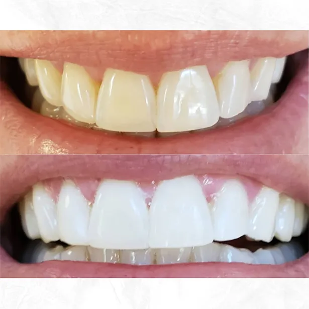 34082 teeth whitening aftercare