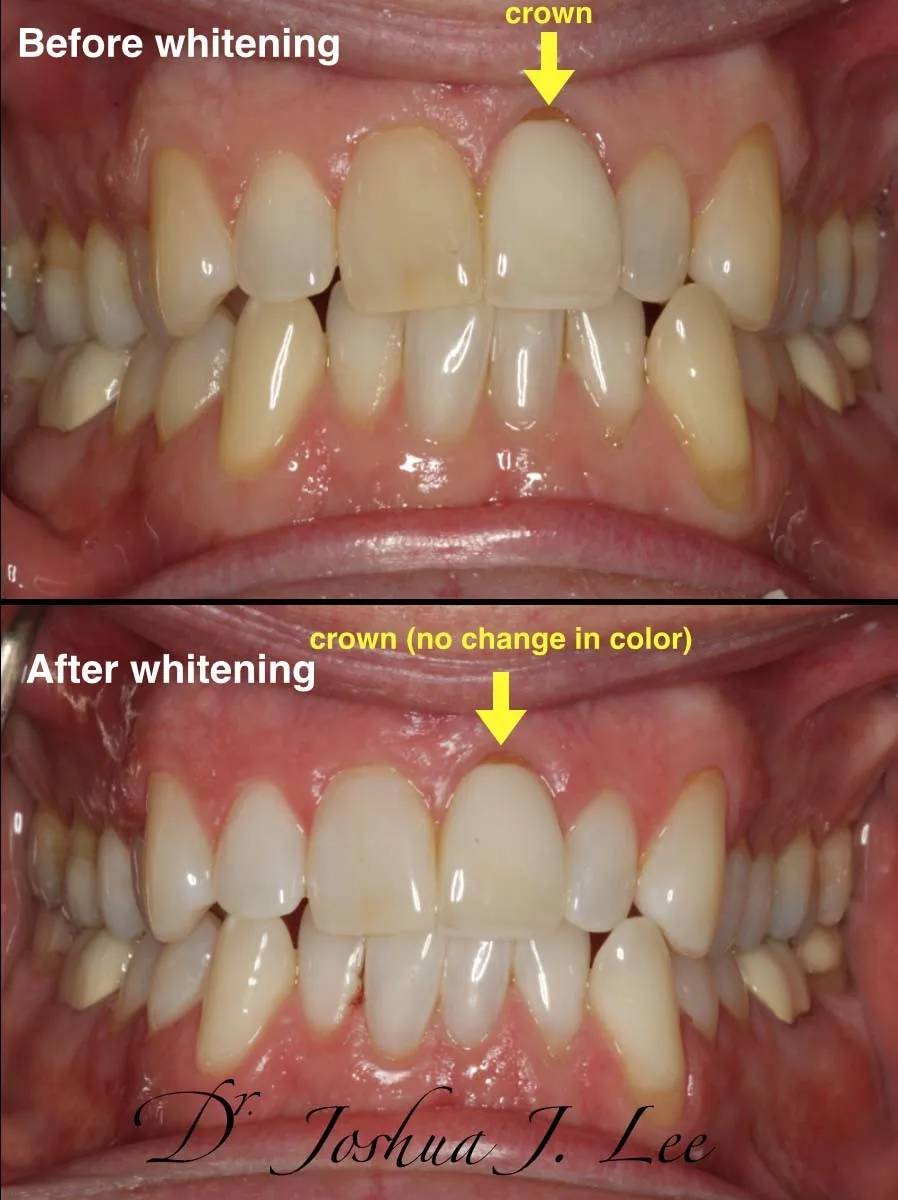 34089 zoom whitening results