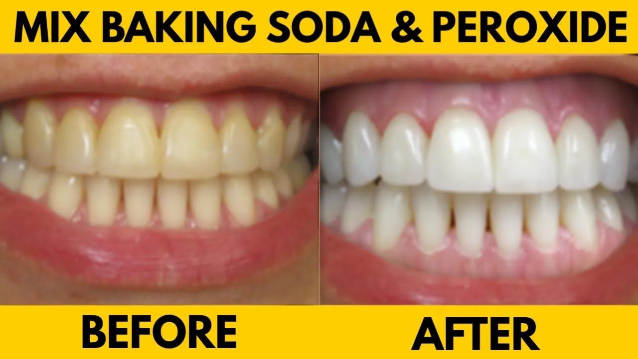 34091 teeth whitening results