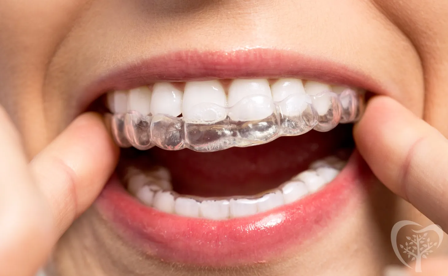 /img/34093-teeth-whitening-benefits.webp