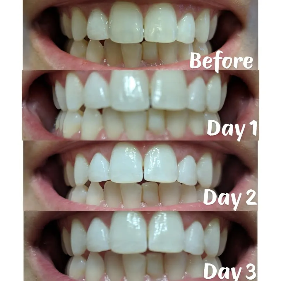 34102 applying 3d whitening strips