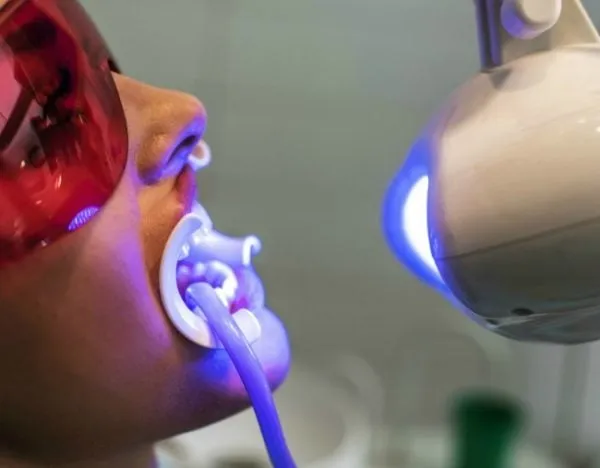 34103 enamel erosion