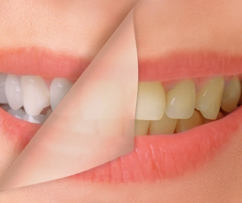 34103 gum irritation