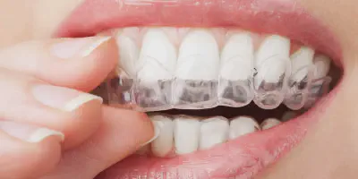 /img/34103-teeth-whitening-guide.webp