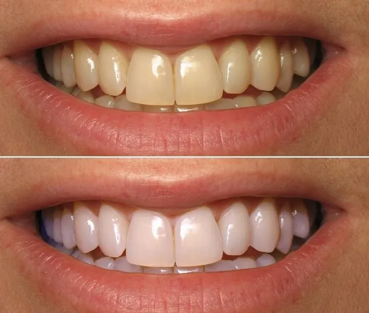 34115 applying whitening strips