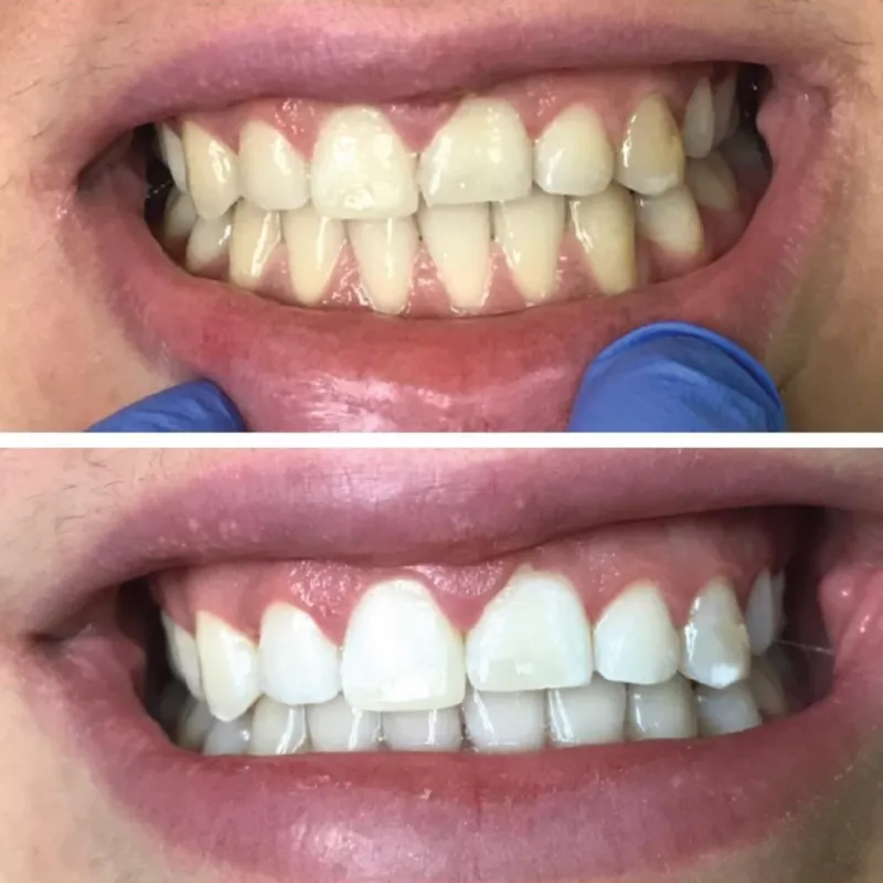 /img/34120-teeth-whitening-before-after.webp