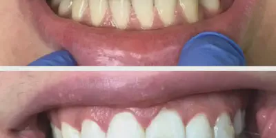 /img/34120-teeth-whitening-before-after.webp