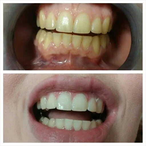 34120 teeth whitening maintenance