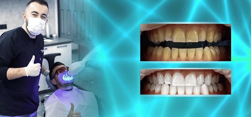 34126 okc teeth whitening before after