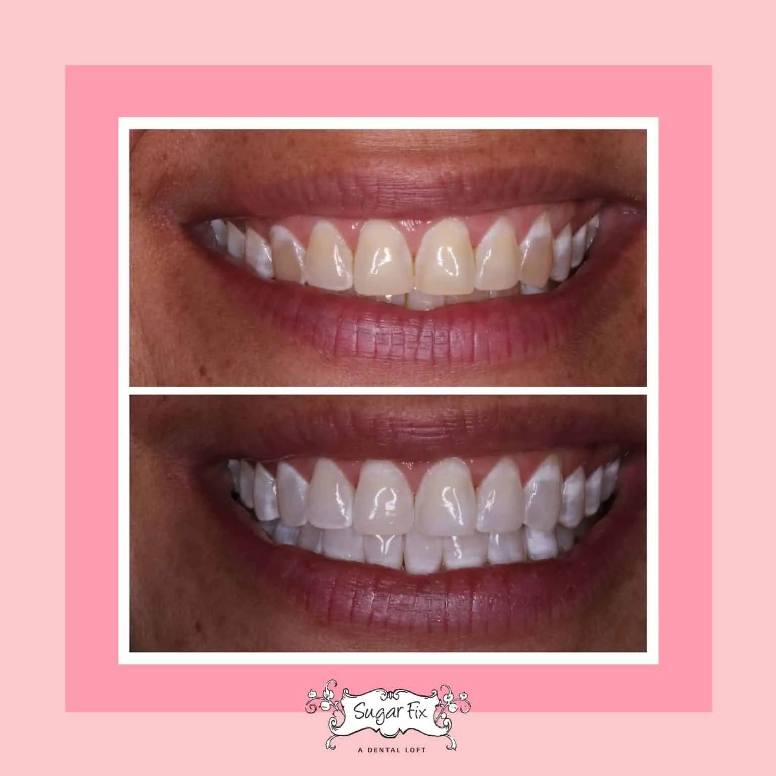 34134 teeth whitening options sutton