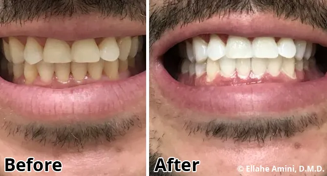 34141 professional teeth cleaning