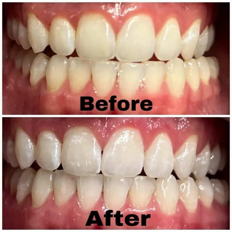 34146 teeth whitening sioux falls 2