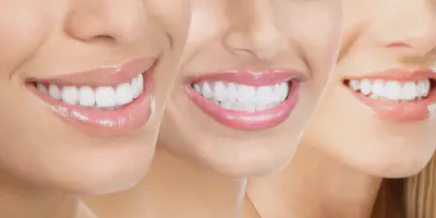 /img/34146-teeth-whitening-sioux-falls-7.webp
