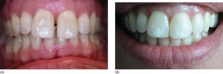 34147 hydrogen peroxide teeth