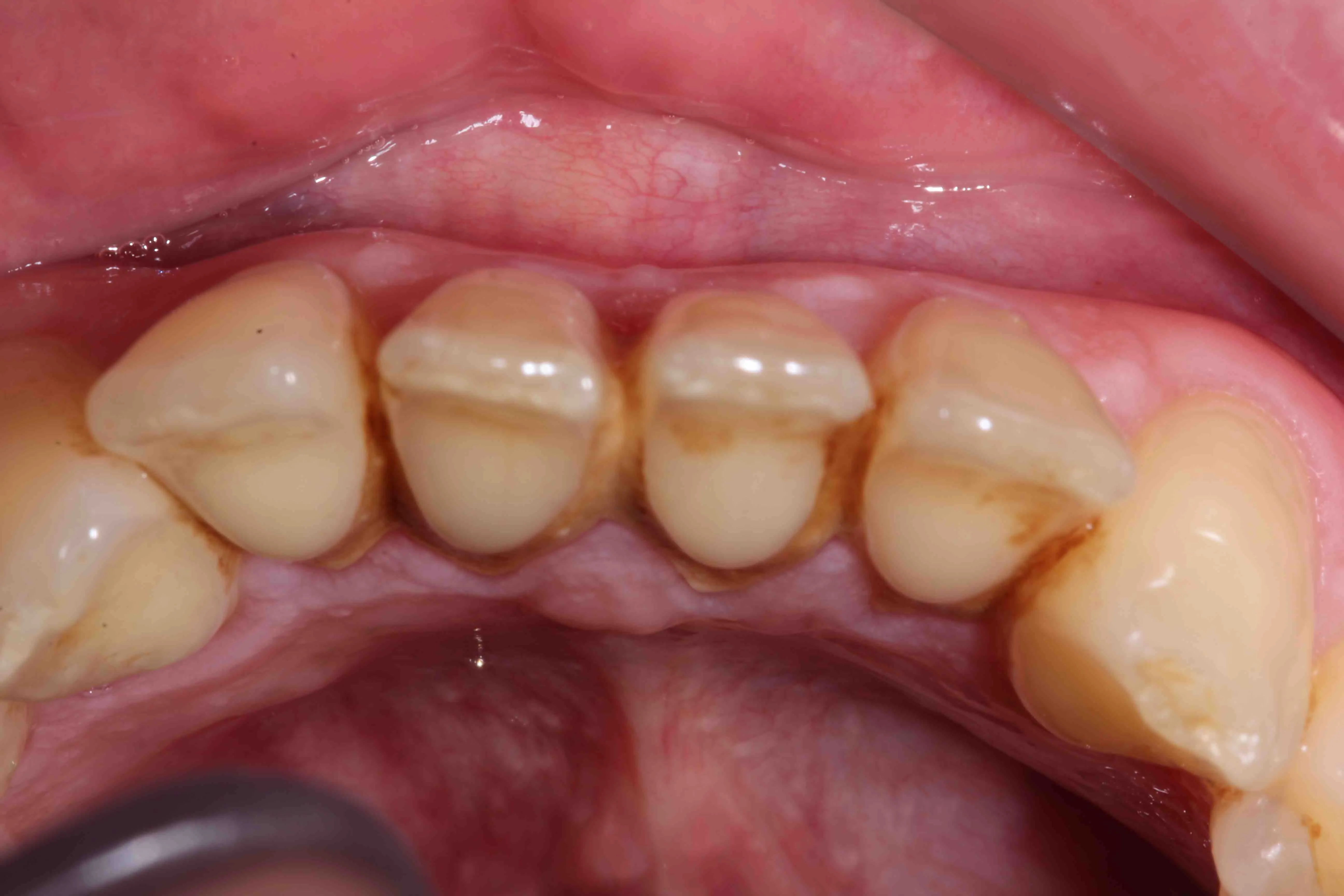 34147 professional teeth whitening