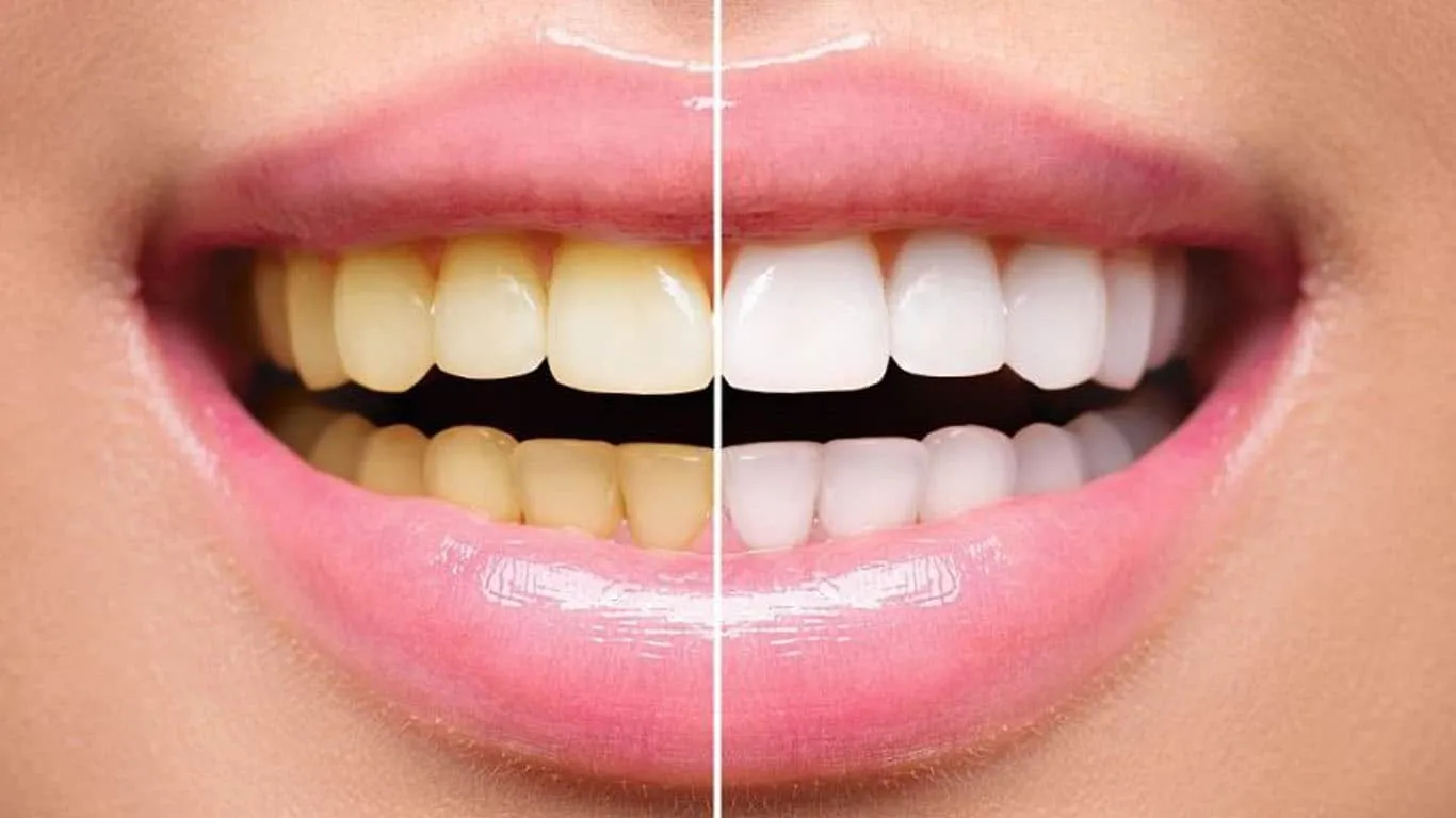 34147 tooth whitening products