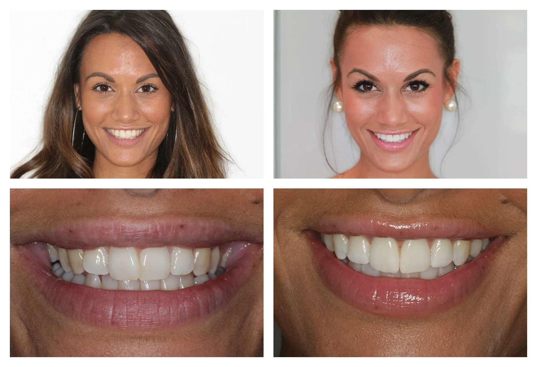 34153 teeth whitening options