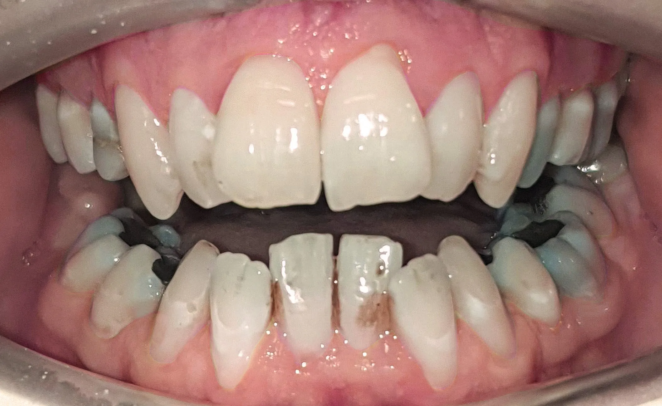 34153 teeth whitening results