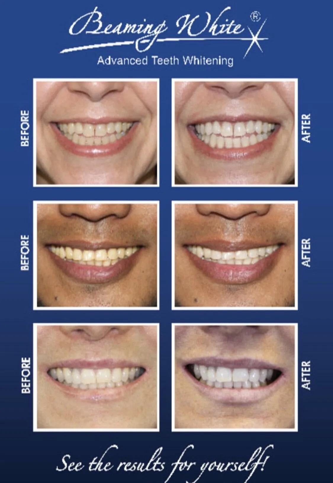 34158 teeth whitening summerlin 4