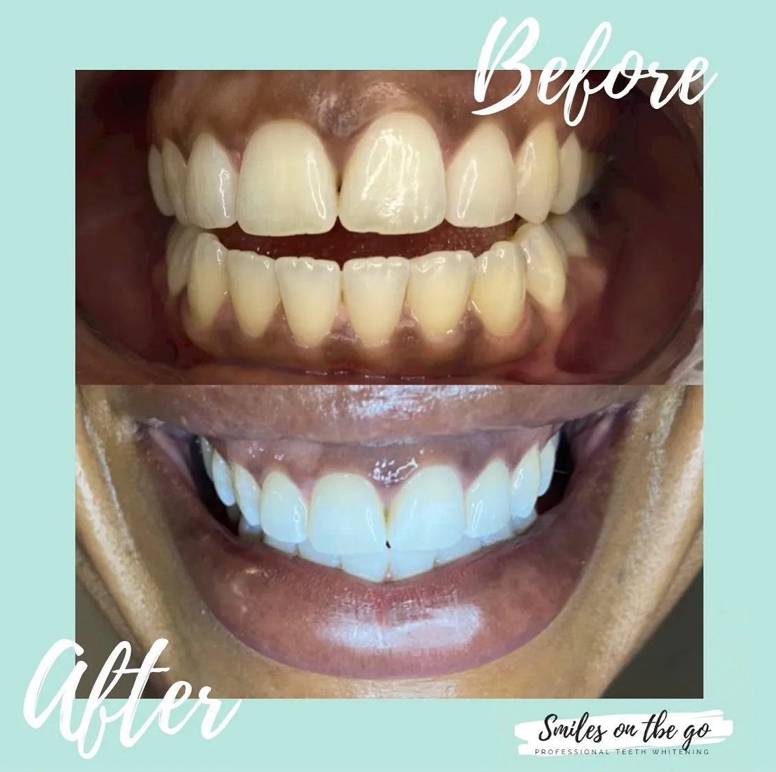 34158 teeth whitening summerlin 6