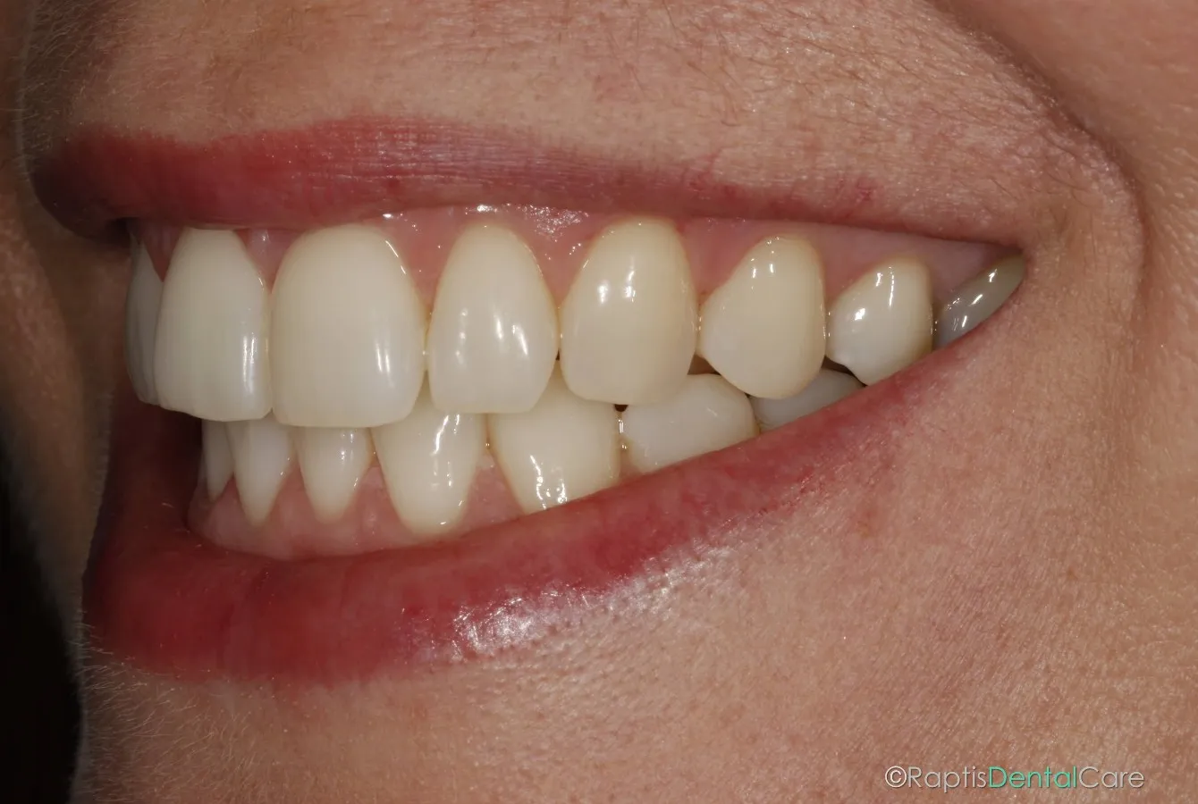 34159 teeth whitening procedure