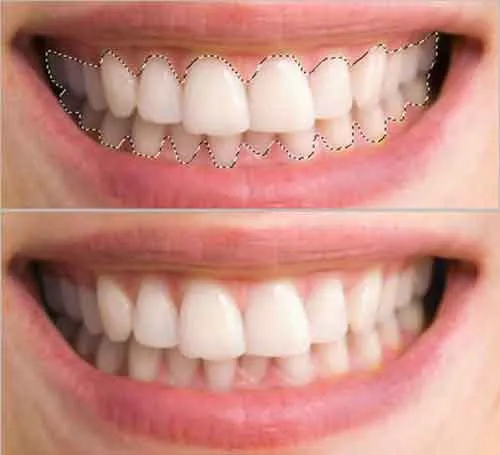 34160 photoshop teeth whitening before after