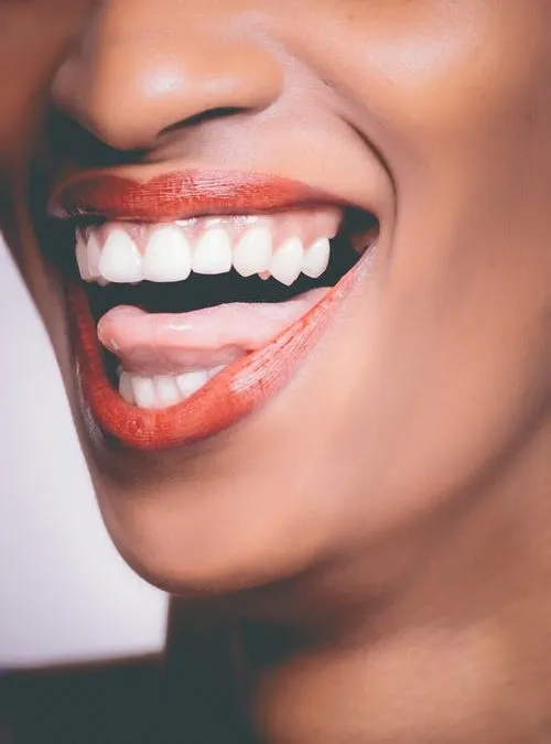 34164 in office teeth whitening