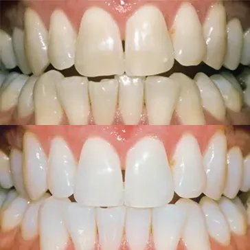 34167 teeth whitening maintenance