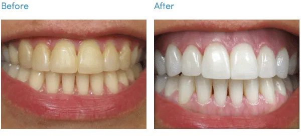 /img/34169-boston-tooth-whitening-before-after.webp