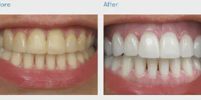 /img/34169-boston-tooth-whitening-before-after.webp