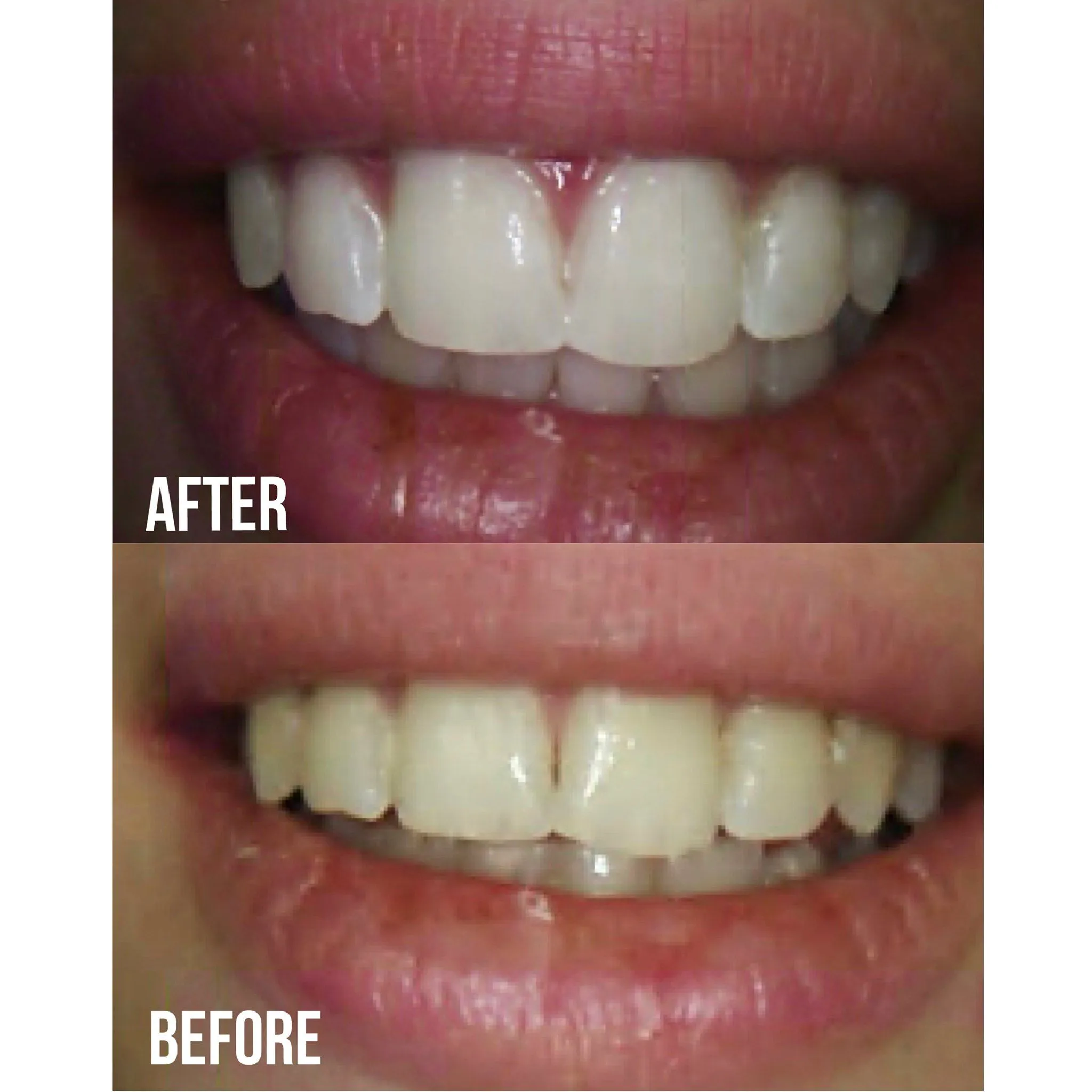 34170 oral hygiene after whitening
