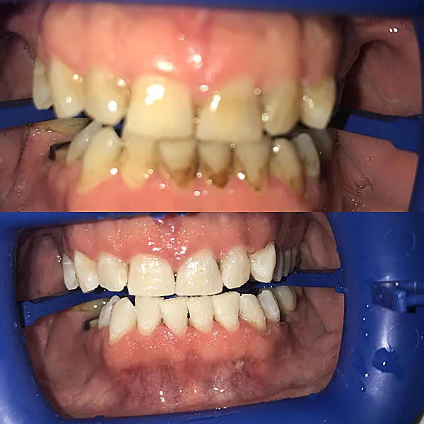 34170 zoom whitening process